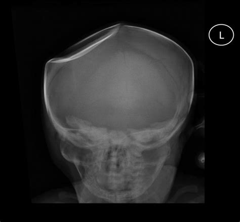 DEPRESSED SKULL FRACTURE-NEWBORN BABY | buyxraysonline