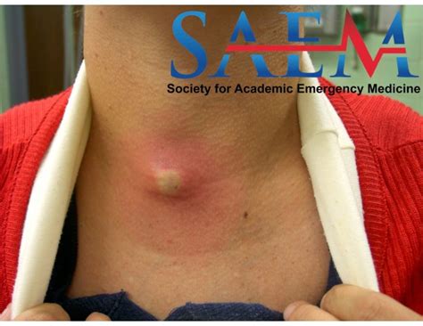 SAEM Clinical Image Series: A Recurring Neck Mass