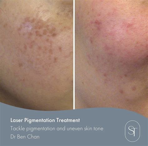 Laser Pigmentation & Age Spot Removal | Skintech