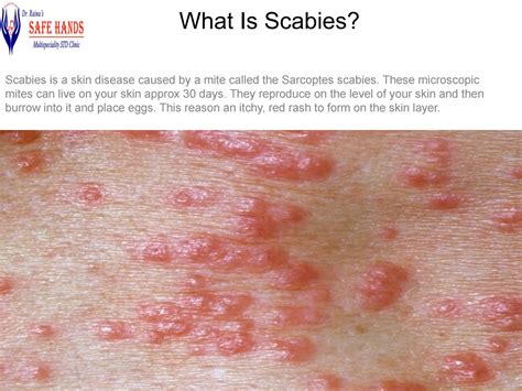 Scabies Treatment Howstuffworks - vrogue.co