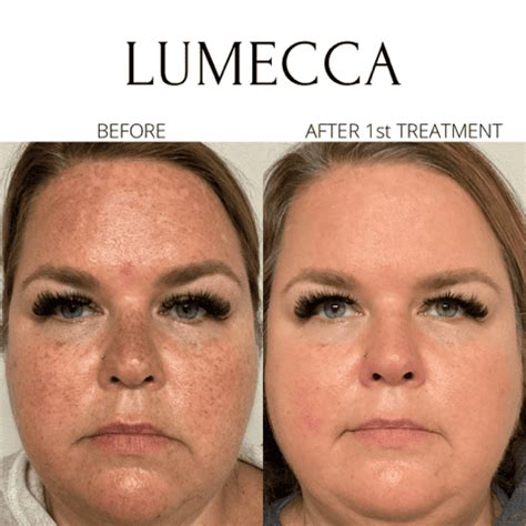 Lumecca IPL Before & After Images | EMME Skin Studio