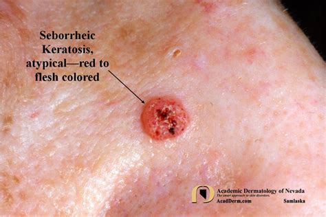 Inflamed Seborrheic Keratosis