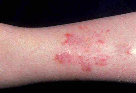 Symptoms of Stasis dermatitis - MEDizzy