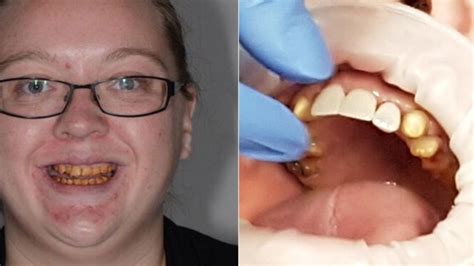 New Zealand Woman suffering from enamel hypoplasia debuts amazing teeth ...