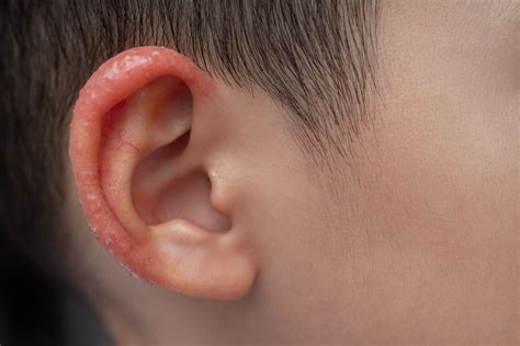 Itchy Ears Beware! Tackling Juvenile Spring Eruption in Kids - NatureDoc
