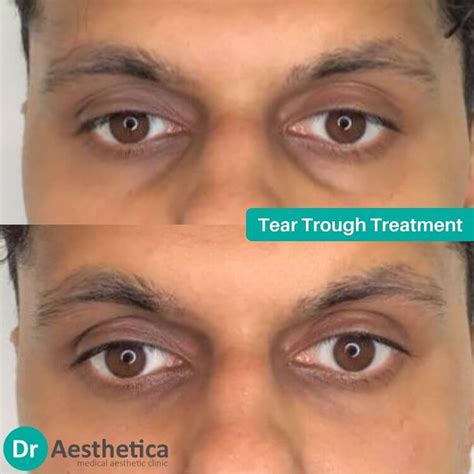 Top Causes for Under Eye Filler Gone Wrong - Dr Aesthetica