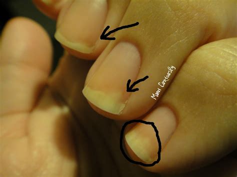 The Remedies For Fungus Under Toenails – Kalo Nero Apts