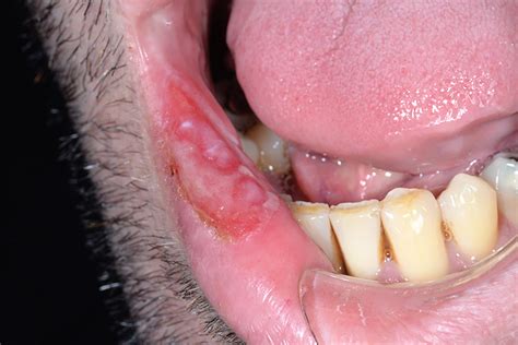 Oral syphilis – A case report - Scottish Dental magazine : Scottish Dental magazine