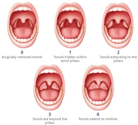 Wednesday Life: [EN] Tonsillitis removed