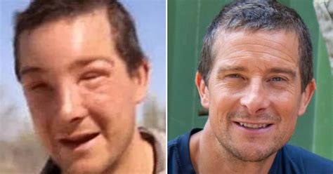 Bear Grylls Needs Medical Treatment After Suffering Severe Reaction To ...