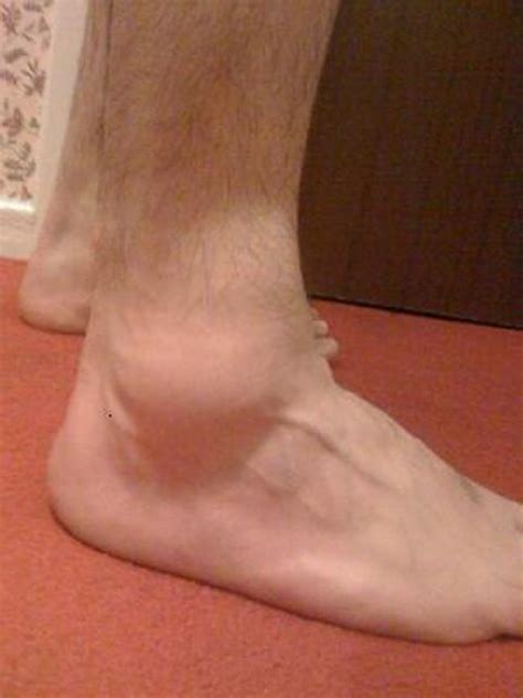 What causes Swollen Ankles? – What causes this?