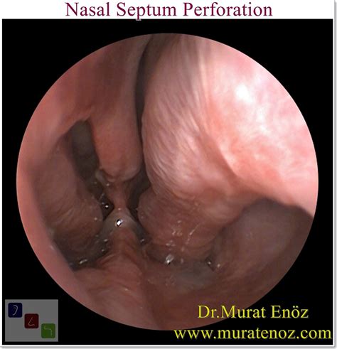 Correcting The Deviated Septum