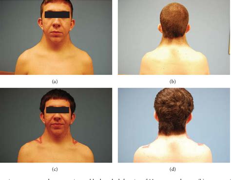 Figure 7 from M to T Rearrangement: An Approach to Correct Webbed Neck ...