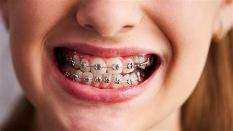 Braces Vs Aligners: Expert Suggests Which Is Better For You | OnlyMyHealth