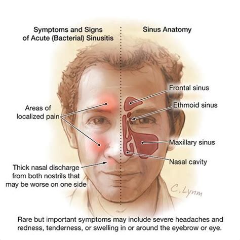 Acute Sinusitis | Sinus infection remedies, Sinusitis, Sinus remedies