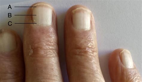 Terry's Nails • LITFL • Medical Eponym Library