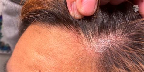 Scalp Infection: Causes, Signs, and Treatment - AHS India