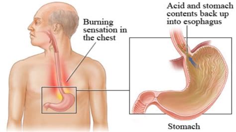 Signs and Symptoms of Acid Reflux - HealthNormal