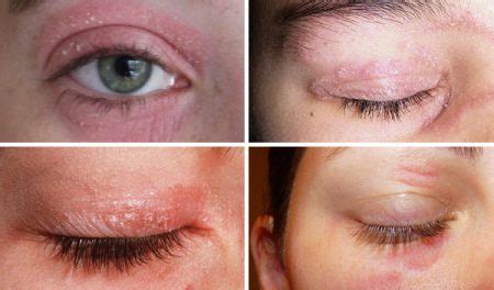 Psoriasis on the eyelids – Causes, Symptoms & Treatment | Psoriasis expert