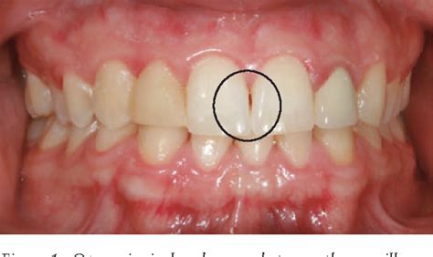 Esthetic considerations in interdental papilla: remediation and regeneration. | Semantic Scholar