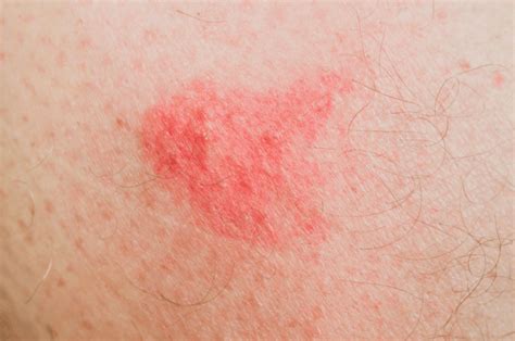 Home Remedies for Sand Fly Bites | Wellnessbin