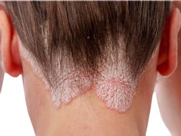 Treatment for Psoriasis Skin Disease - Dr. Sunil Dubey