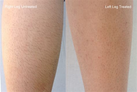 Top 48 image laser hair removal near me - Thptnganamst.edu.vn