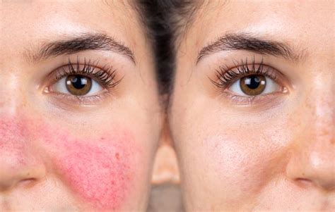 Skincare FAQs | What is the best laser treatment for Rosacea?