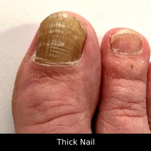 Common Nail Disorders | Foot Focus Podiatry | Perth Podiatrists