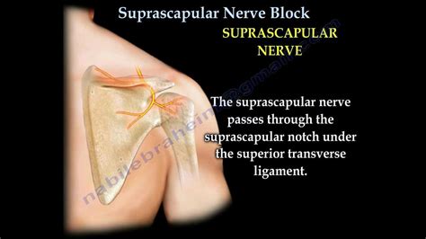 Shoulder Pain Injection Suprascapular Nerve Block - Everything You Need To Know - Dr. Nabil ...