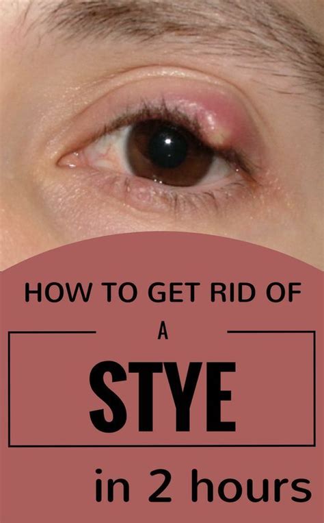 What To Do For A Stye On Upper Eyelid