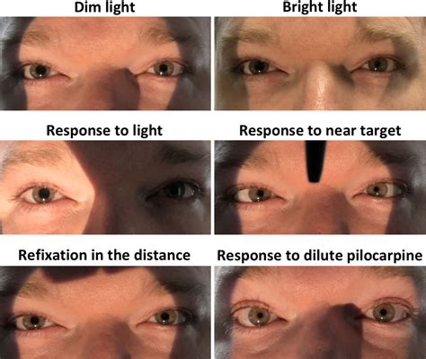 Adie’s tonic pupil presenting with unilateral photophobia successfully treated with dilute ...