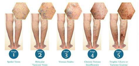 Chronic Venous Insufficiency | Stages of Venous Disease | Venous Stasis