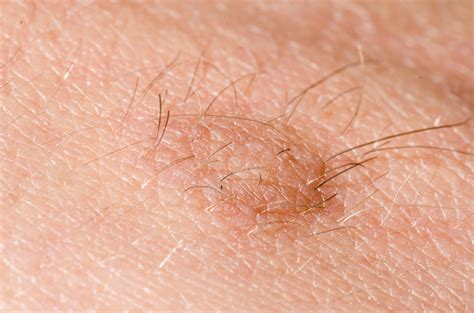 What Is Medical Term For Skin Tag at Mark Ramos blog