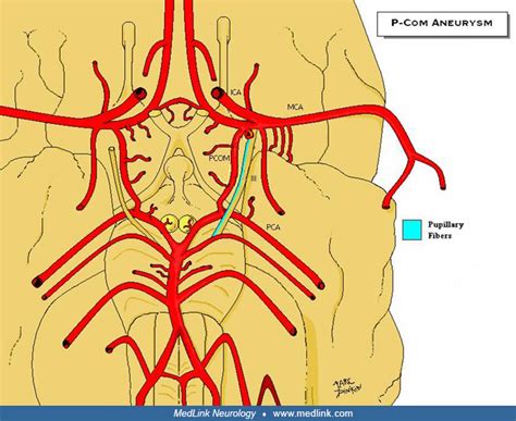 Third nerve palsy | MedLink Neurology