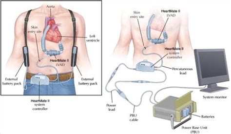 LVAD Problems and Troubleshooting - ED ECMO