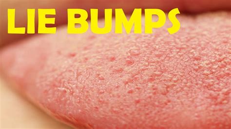 how to get rid of red bumps on tongue - YouTube