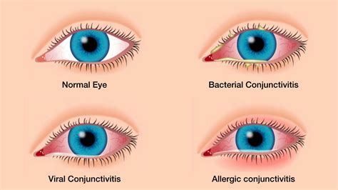 Tổng hợp các câu hỏi thường gặp về bệnh đau mắt đỏ ở trẻ nhỏ