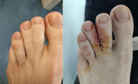 Syndactyly – (Webbed Toes) | Foot & Podiatry Surgery