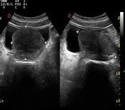 Benign prostatic hyperplasia | Radiology Reference Article | Radiopaedia.org