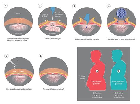 incisional-and-ventral-hernia-repair-2.jpg | A/Prof Jaber