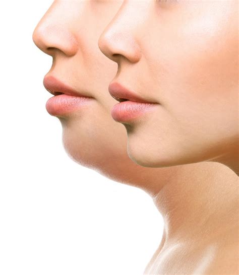 What Causes a Double Chin?: Skinworks Dermatology: Dermatology