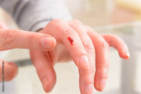 Bleeding finger, hand with a wound Stock Photo | Adobe Stock