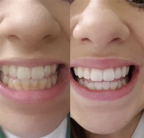 Laser Teeth Whitening Vs Professional Lightening Trays