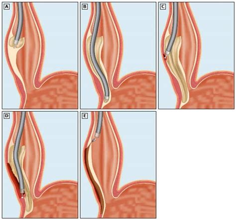 What To Expect After Poem Surgery | Sitedoct.org