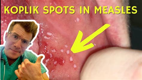 Doctor explains Koplik Spots seen in Measles (with examples) | Doctor O'Donovan - YouTube