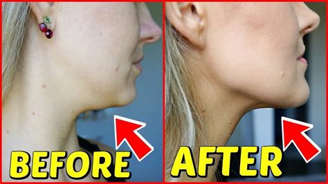 KYBELLA BEFORE AND AFTER 1 MONTH PICTURES - YouTube