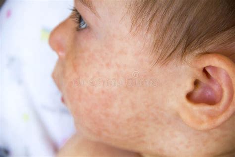 Food Allergy Skin Rash Baby