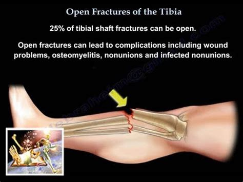 Open Fractures Of The Tibia - Everything You Need To Know - Dr. Nabil ...