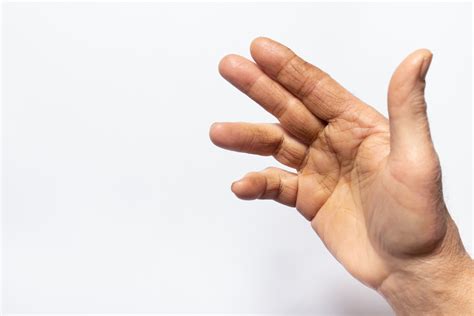 What is Dupuytren's Contracture? | Centennial Orthopedics & Podiatry